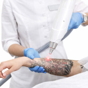 Remoción de Tatuajes Chicos (hasta 2×2 cm)